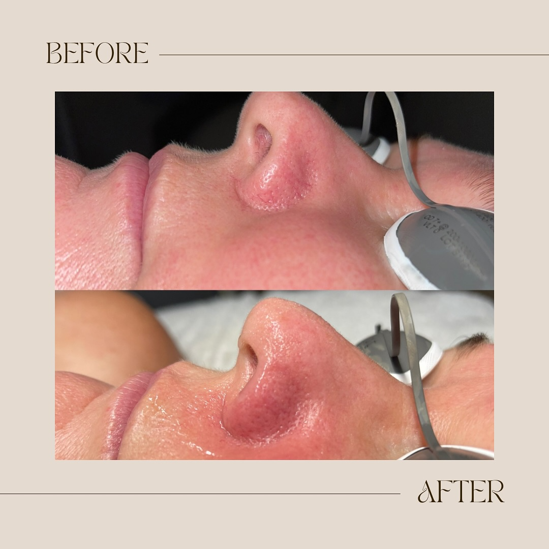Before and after skin treatment result