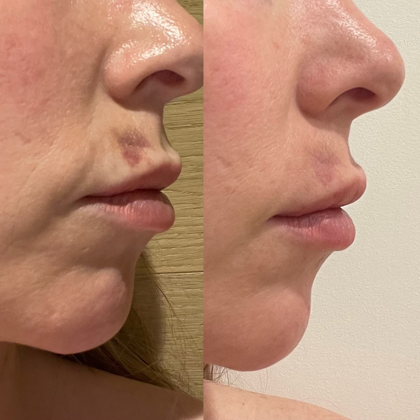Before and after skin treatment result