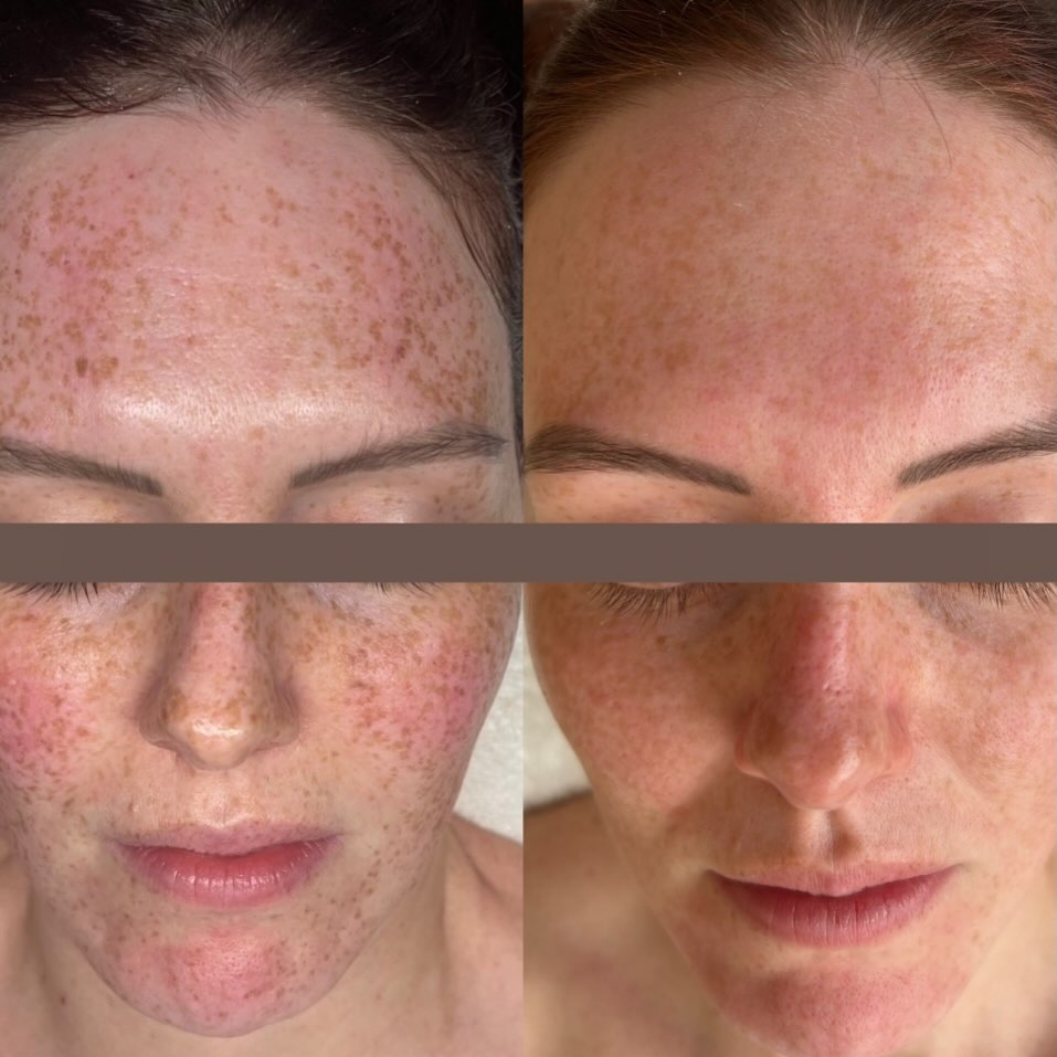 Before and after skin treatment result