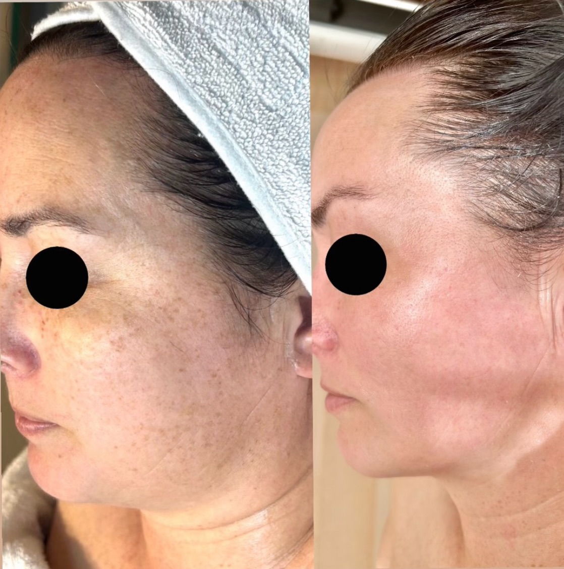 Before and after skin treatment result