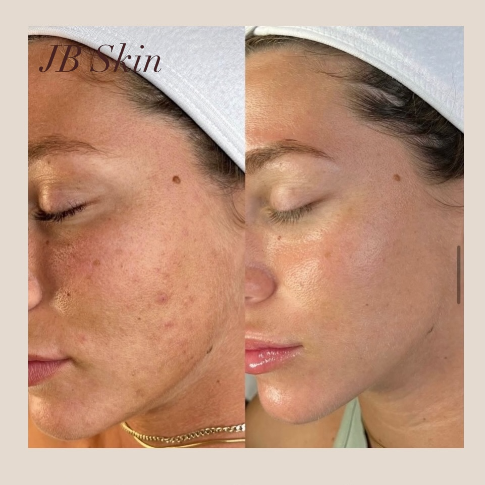 Before and after skin treatment result