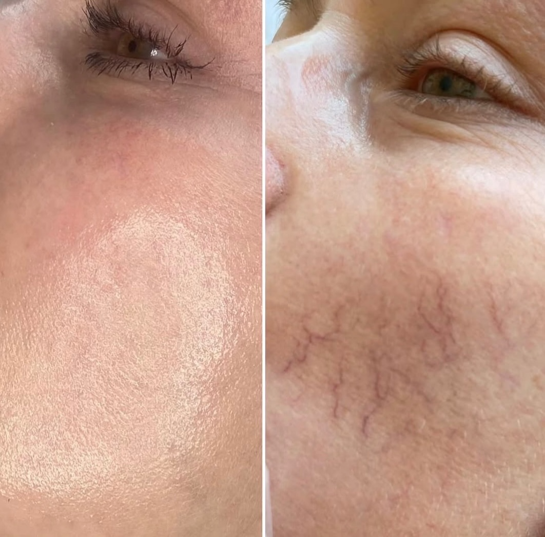 Before and after skin treatment result