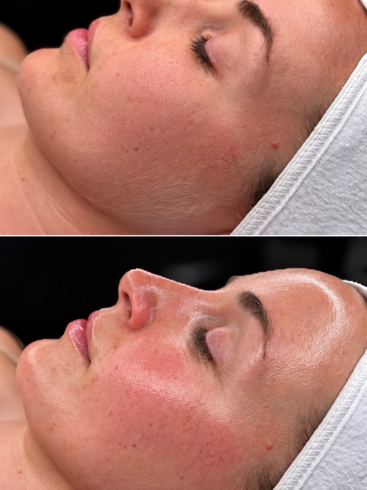 Before and after skin treatment result