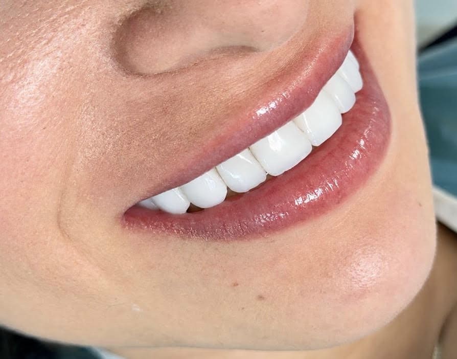 Primer plano de la sonrisa de un adulto después de un diseño de sonrisa, con luz natural, en el consultorio de Santa Marta