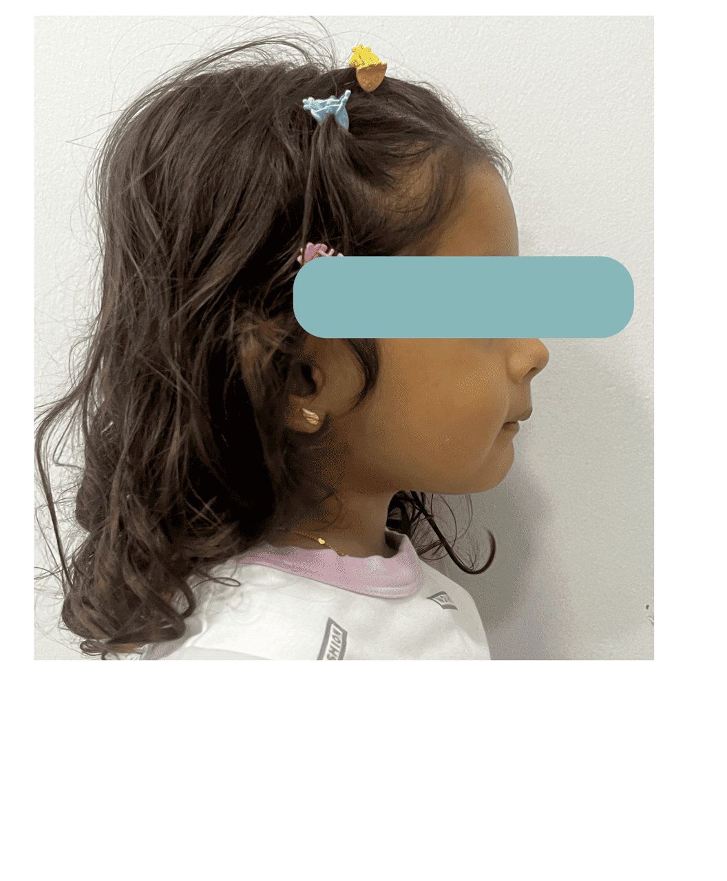 Niña paciente de odontopediatría del consultorio Sindy Lugo Q después del tratamiento, de perfil con el rostro protegido, en Santa Marta