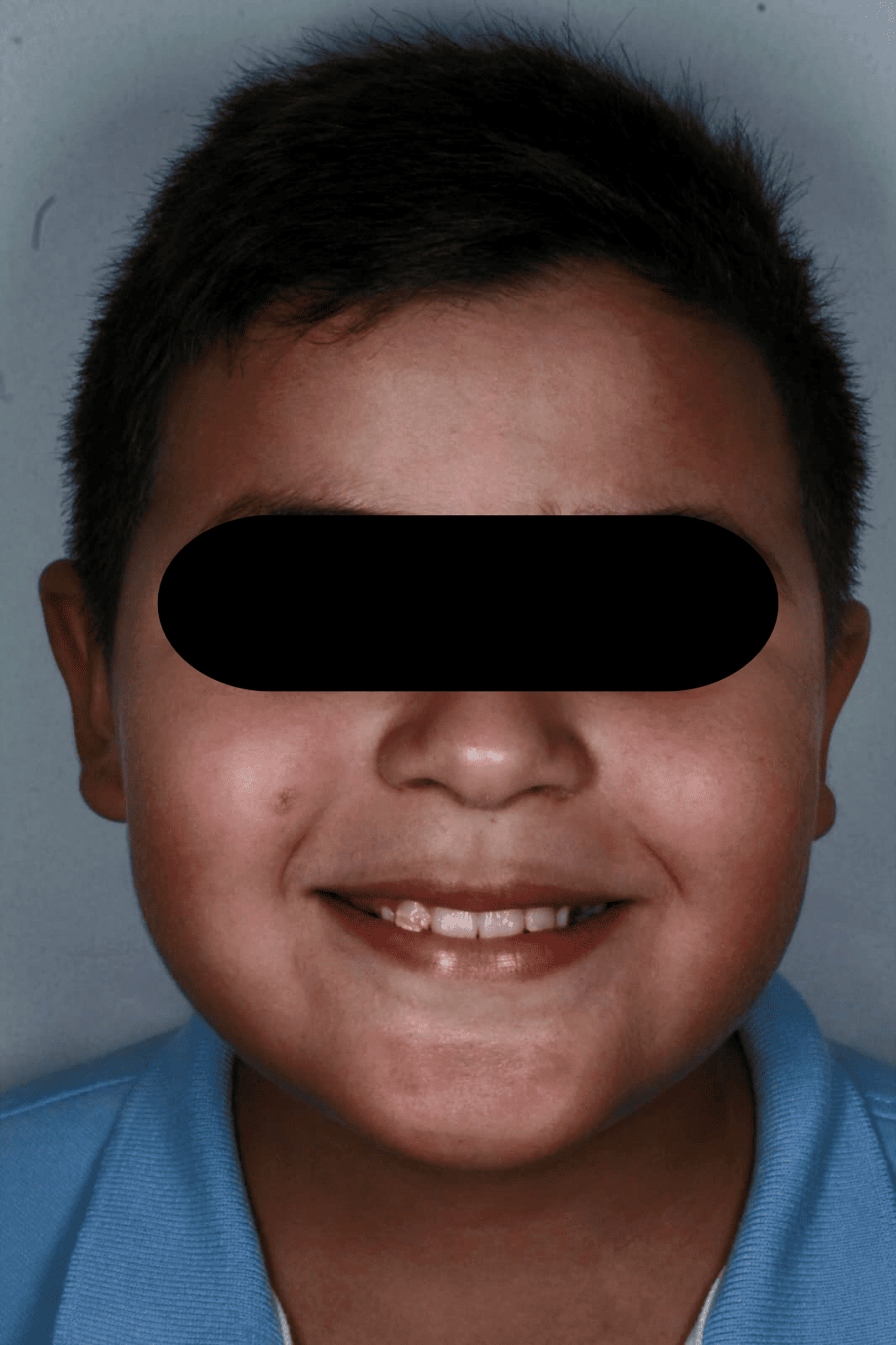 Niño paciente de odontopediatría del consultorio Sindy Lugo Q antes del tratamiento, con el rostro protegido, en Santa Marta