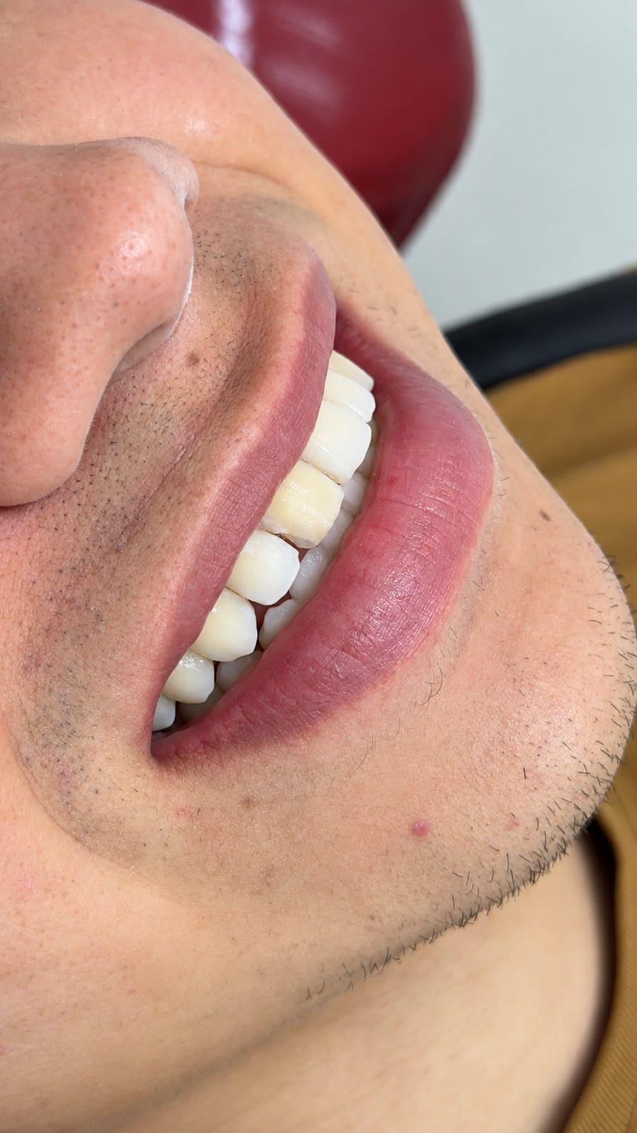 Sonrisa de un adulto después del diseño de sonrisa, vista de la boca con dientes blancos, en Santa Marta