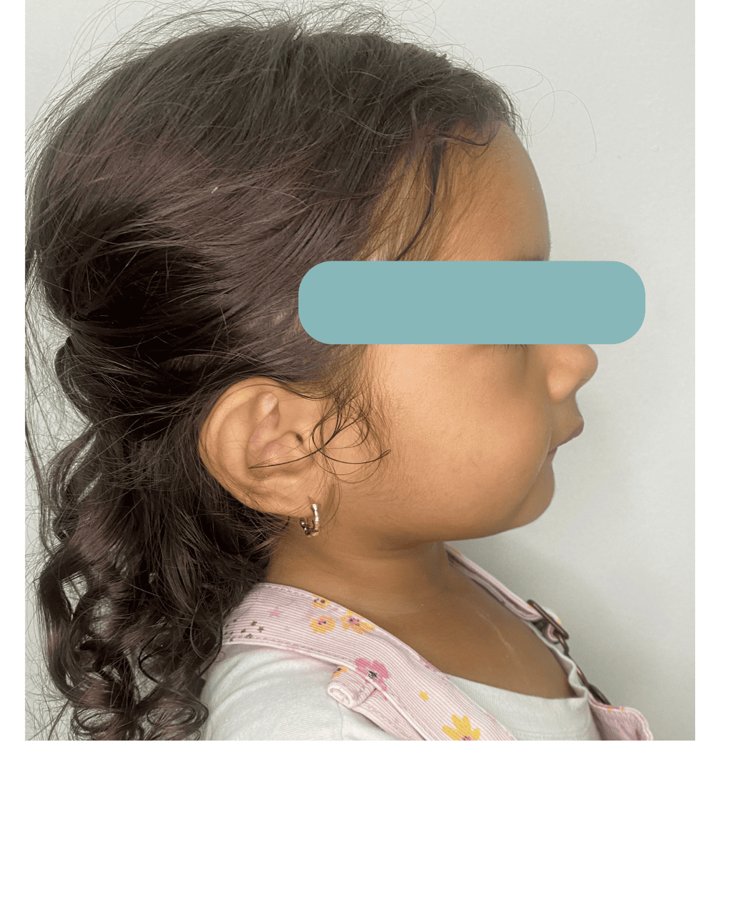 Niña paciente de odontopediatría del consultorio Sindy Lugo Q antes del tratamiento, de perfil con el rostro protegido, en Santa Marta