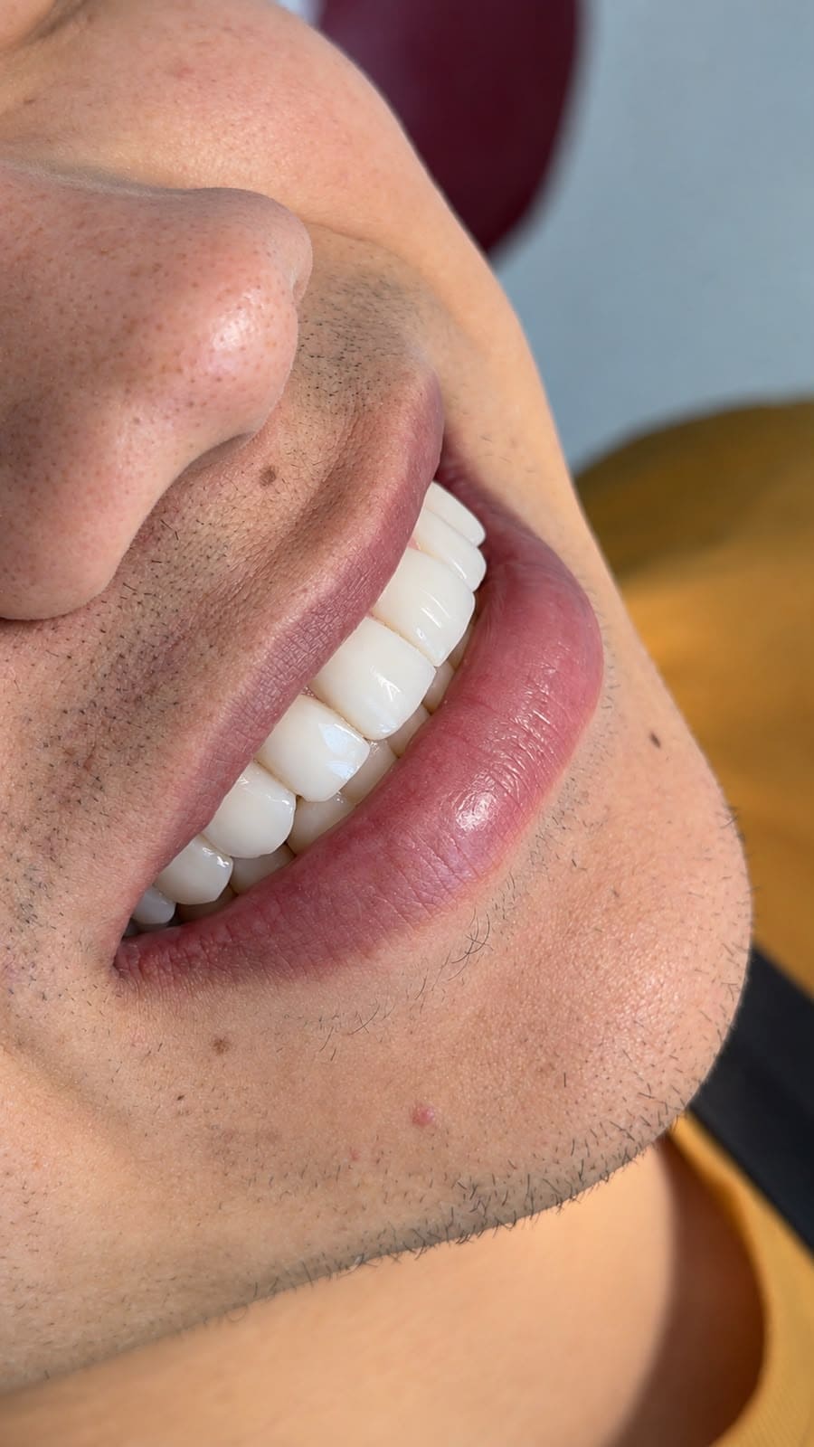 Sonrisa de un adulto después del diseño de sonrisa, vista de la boca con dientes blancos, en Santa Marta