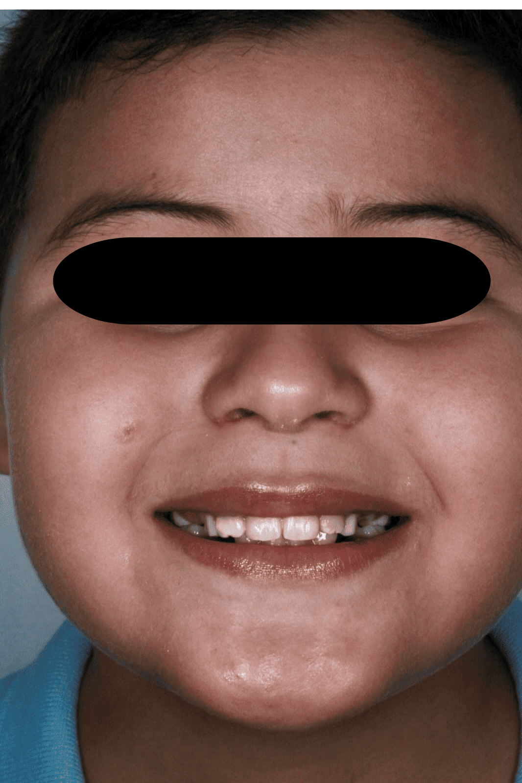 Niño paciente de odontopediatría del consultorio Sindy Lugo Q después del tratamiento, con el rostro protegido, en Santa Marta