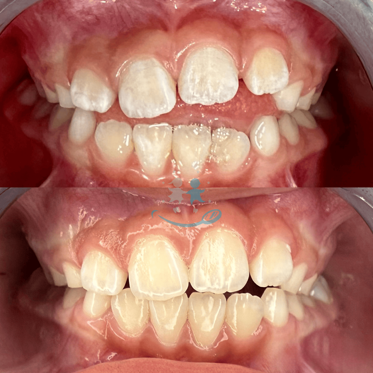Collage antes y después de un diseño de sonrisa de un adulto, con desgaste al inicio y superficie lisa al final, en Santa Marta