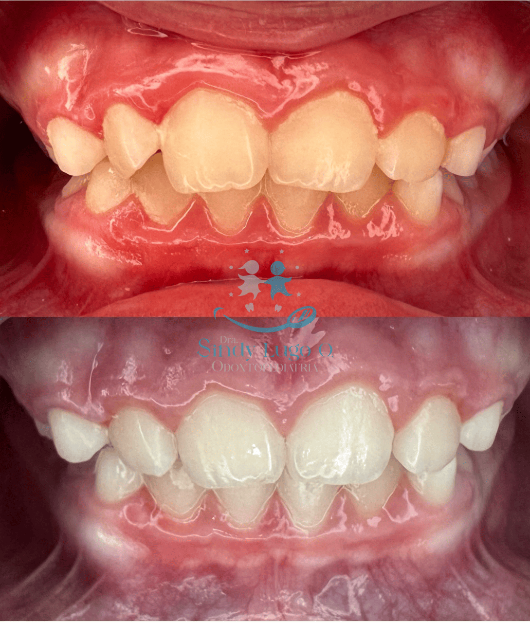 Collage antes y después de ortodoncia, con dientes apiñados al inicio y alineados al final, en Santa Marta