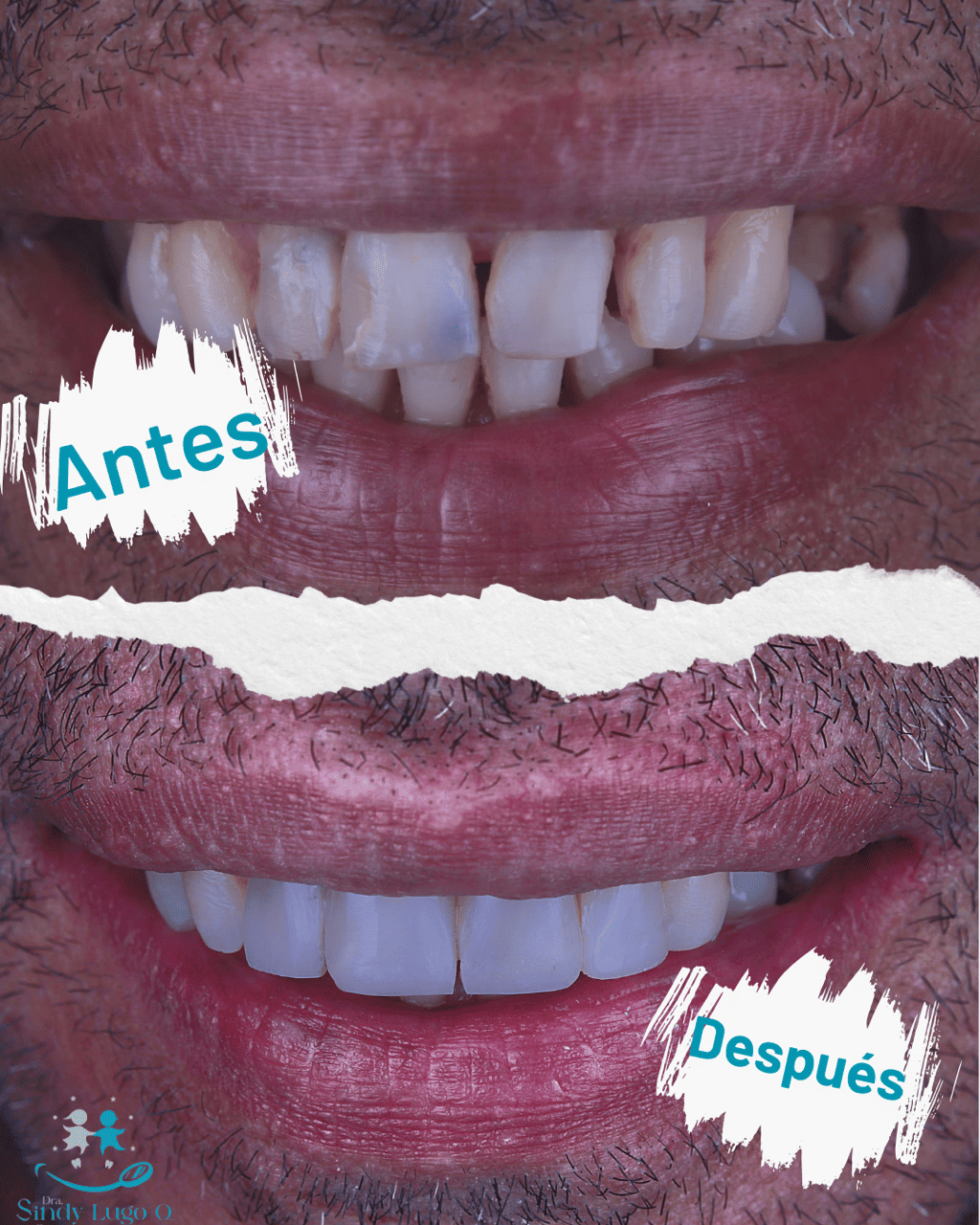Collage antes y después de un diseño de sonrisa de un adulto, con desgaste dental al inicio y sonrisa limpia al final, en Santa Marta