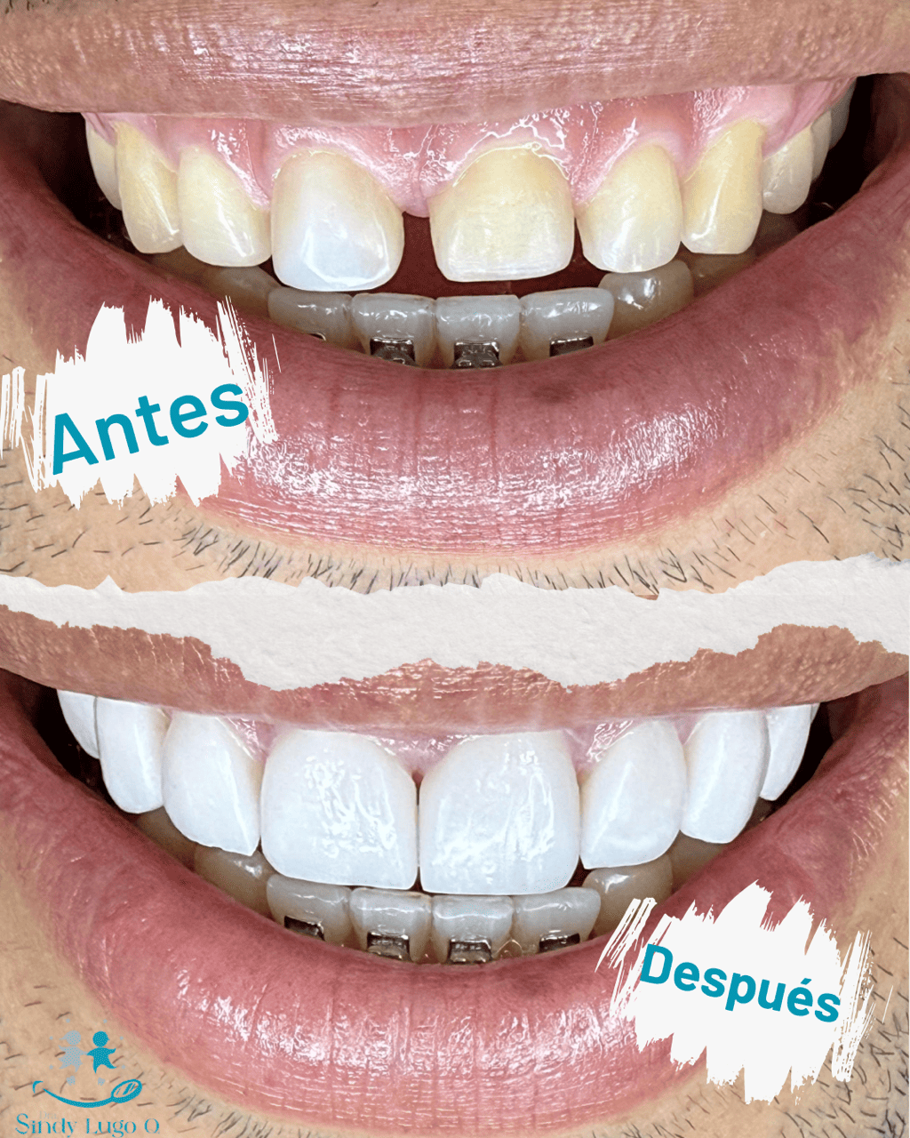 Collage antes y después de un diseño de sonrisa de un adulto, con dientes amarillentos al inicio y blancos al final, en Santa Marta