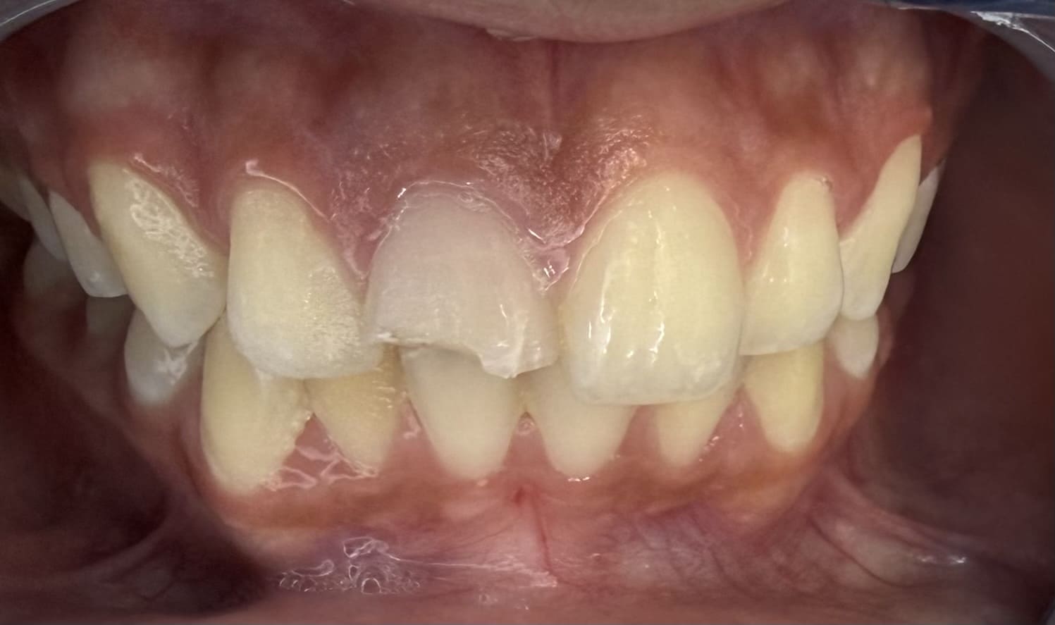 Sonrisa de un adulto antes del diseño de sonrisa, vista frontal de la boca, en Santa Marta