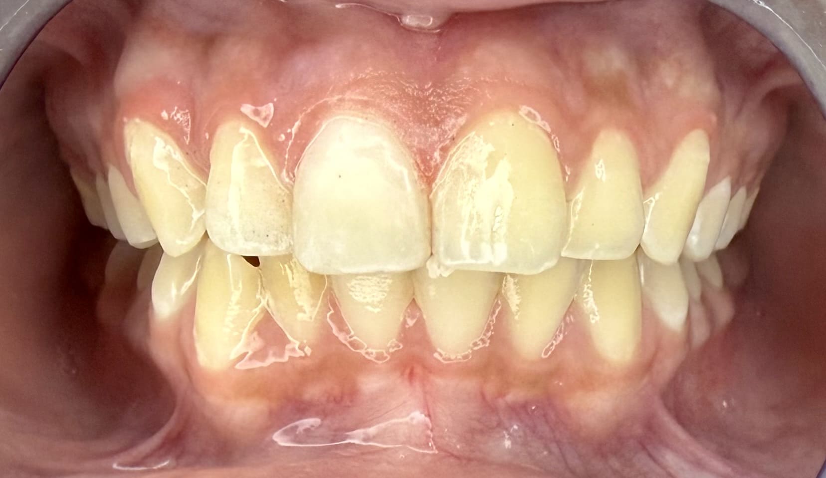 Sonrisa de un adulto después del diseño de sonrisa, con dientes blancos, en Santa Marta