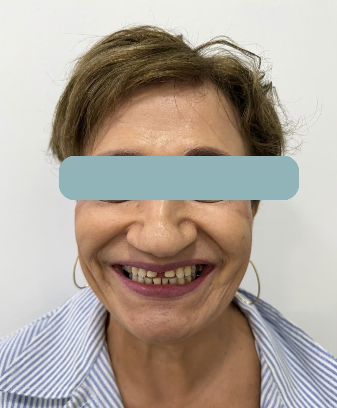 Sonrisa de una mujer adulta antes del diseño de sonrisa, sobre fondo blanco, en Santa Marta