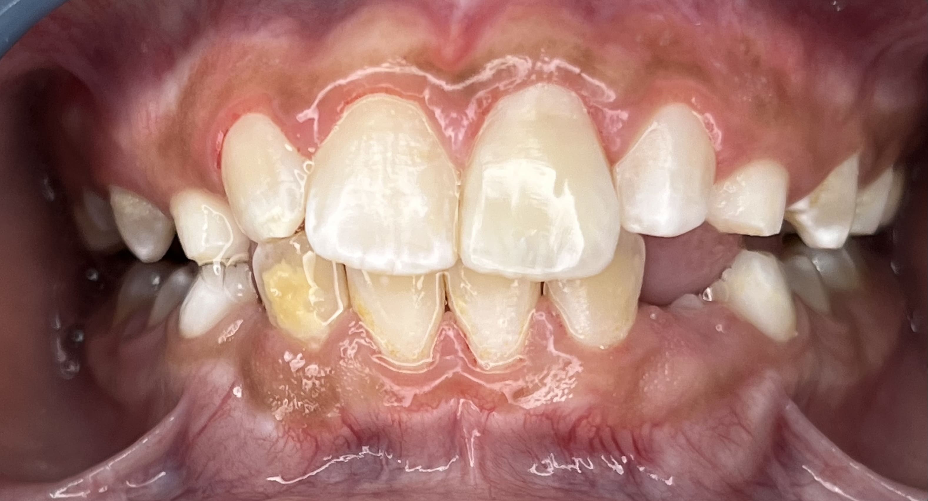 Sonrisa de un adulto después del diseño de sonrisa, con dientes sanos, en Santa Marta