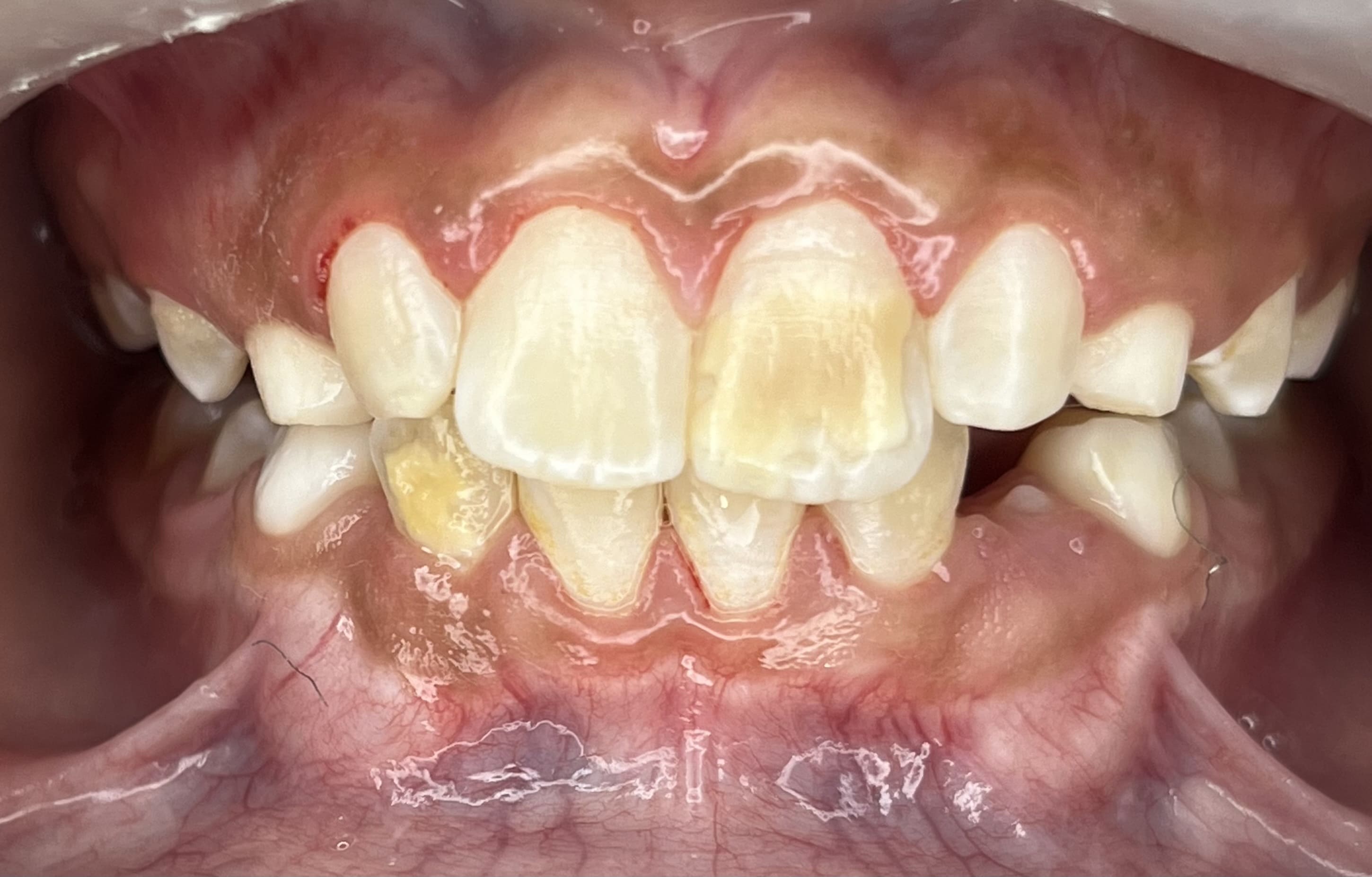 Sonrisa de un adulto antes del diseño de sonrisa, con dientes amarillentos, en Santa Marta
