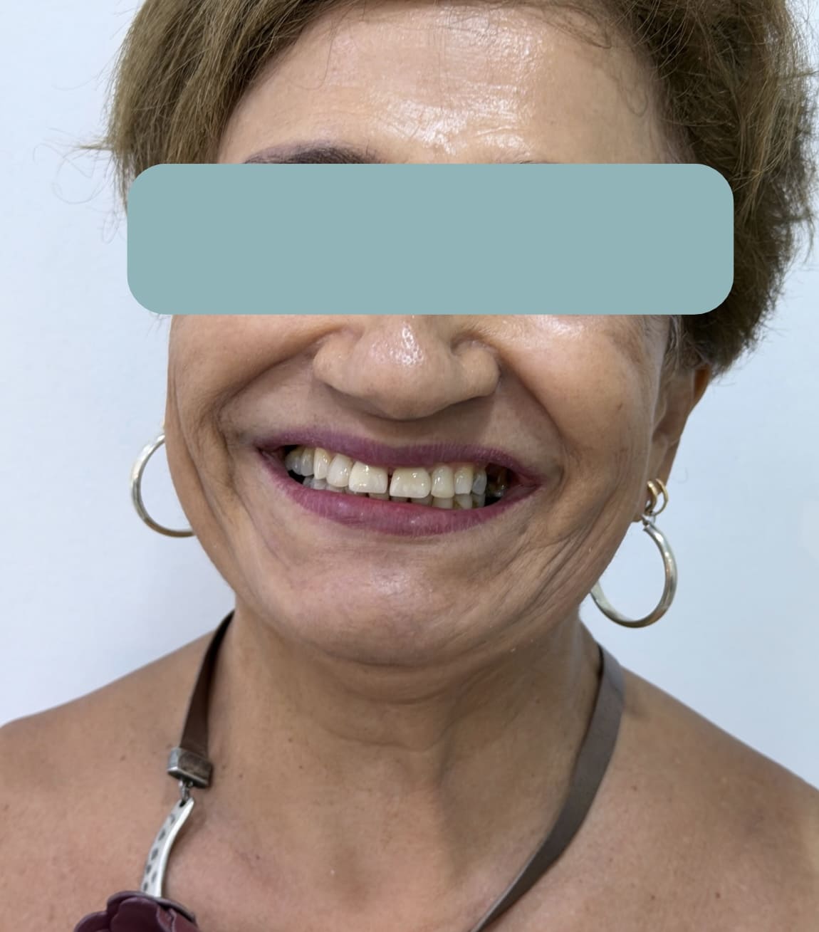 Sonrisa de una mujer adulta después del diseño de sonrisa, en Santa Marta