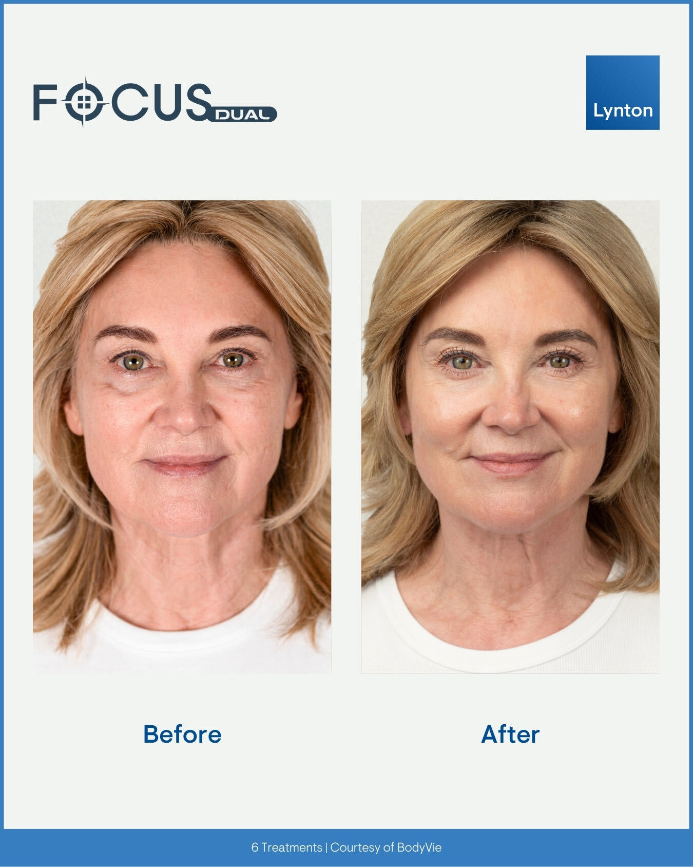After Focus Dual treatment