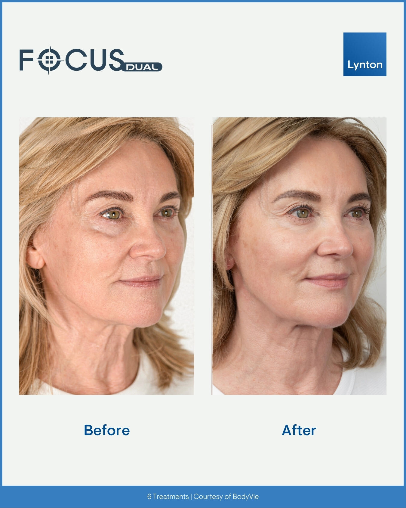 Before Focus Dual treatment