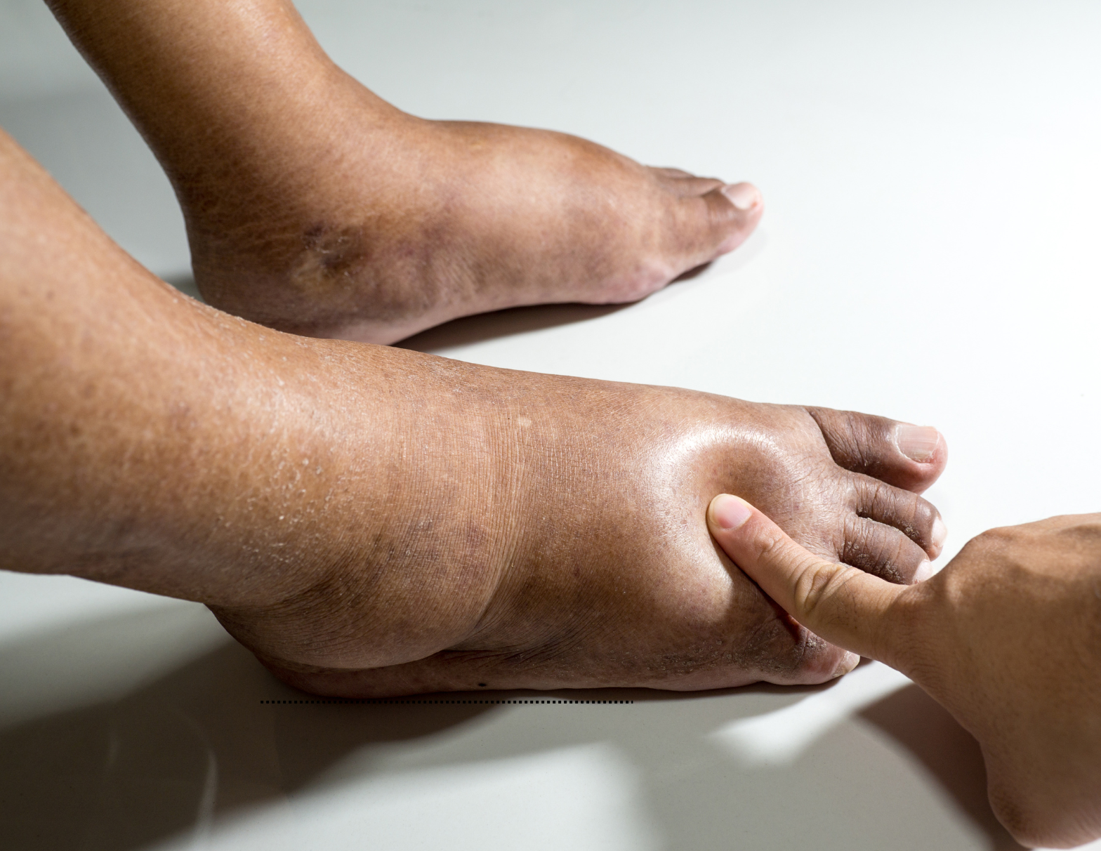 Close-up of a swollen lower leg showing visible pitting edema, a common sign of lymphedema
