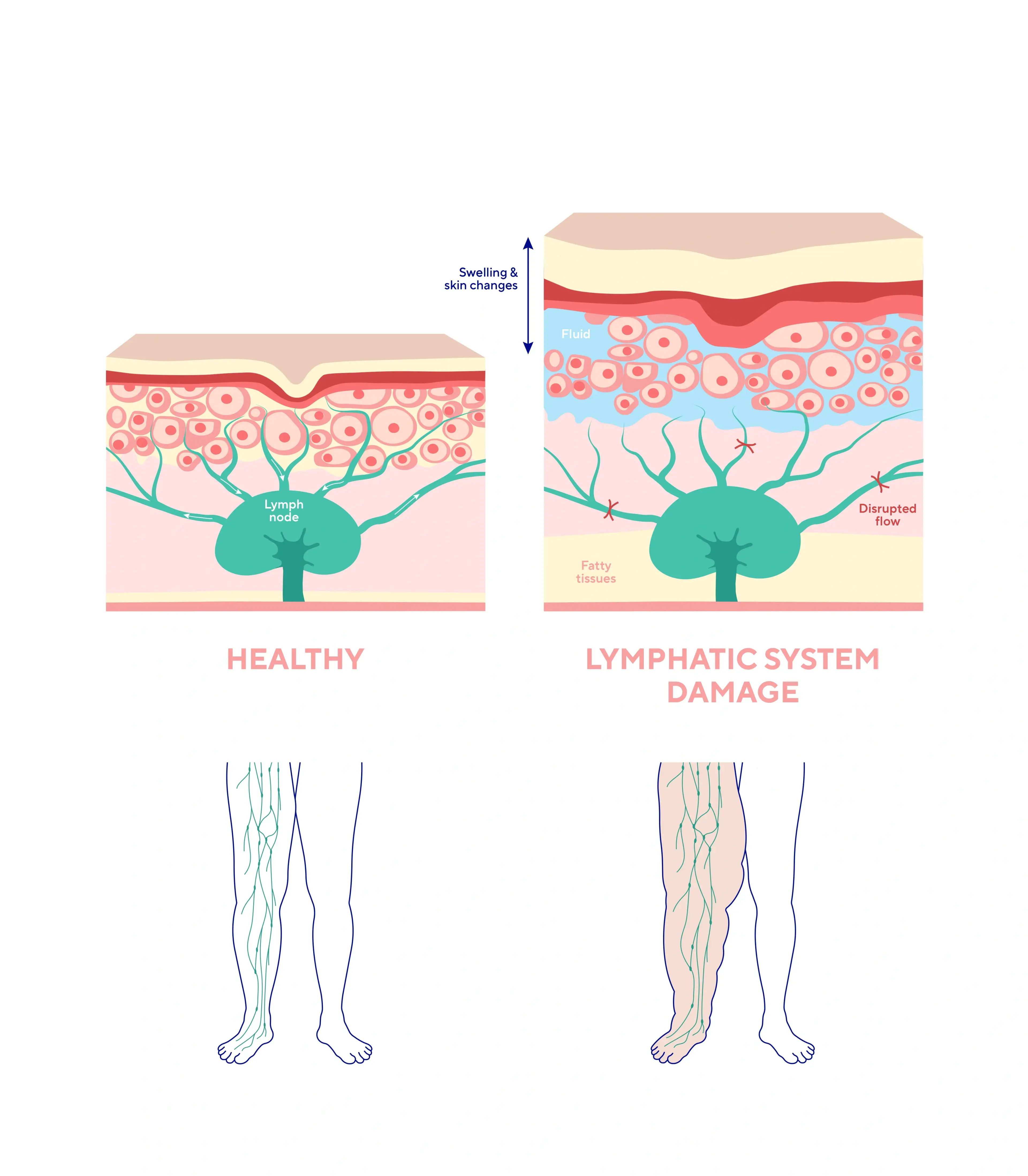 Side-by-side comparison illustration showing lymphedema swelling versus normal water retention edema