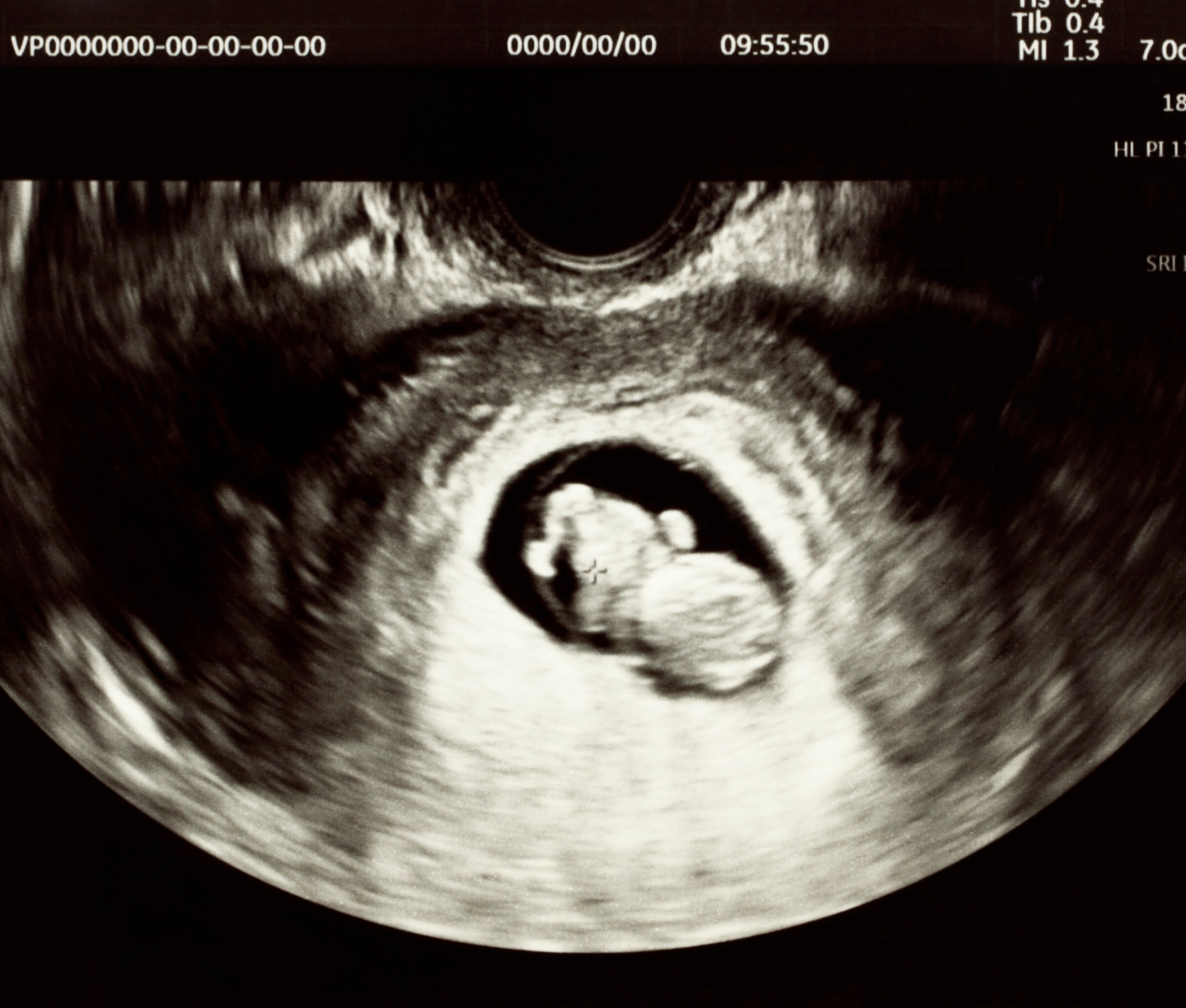 Ultrasound monitor showing a 9-week fetal image, Lighthouse PRC Hawthorne