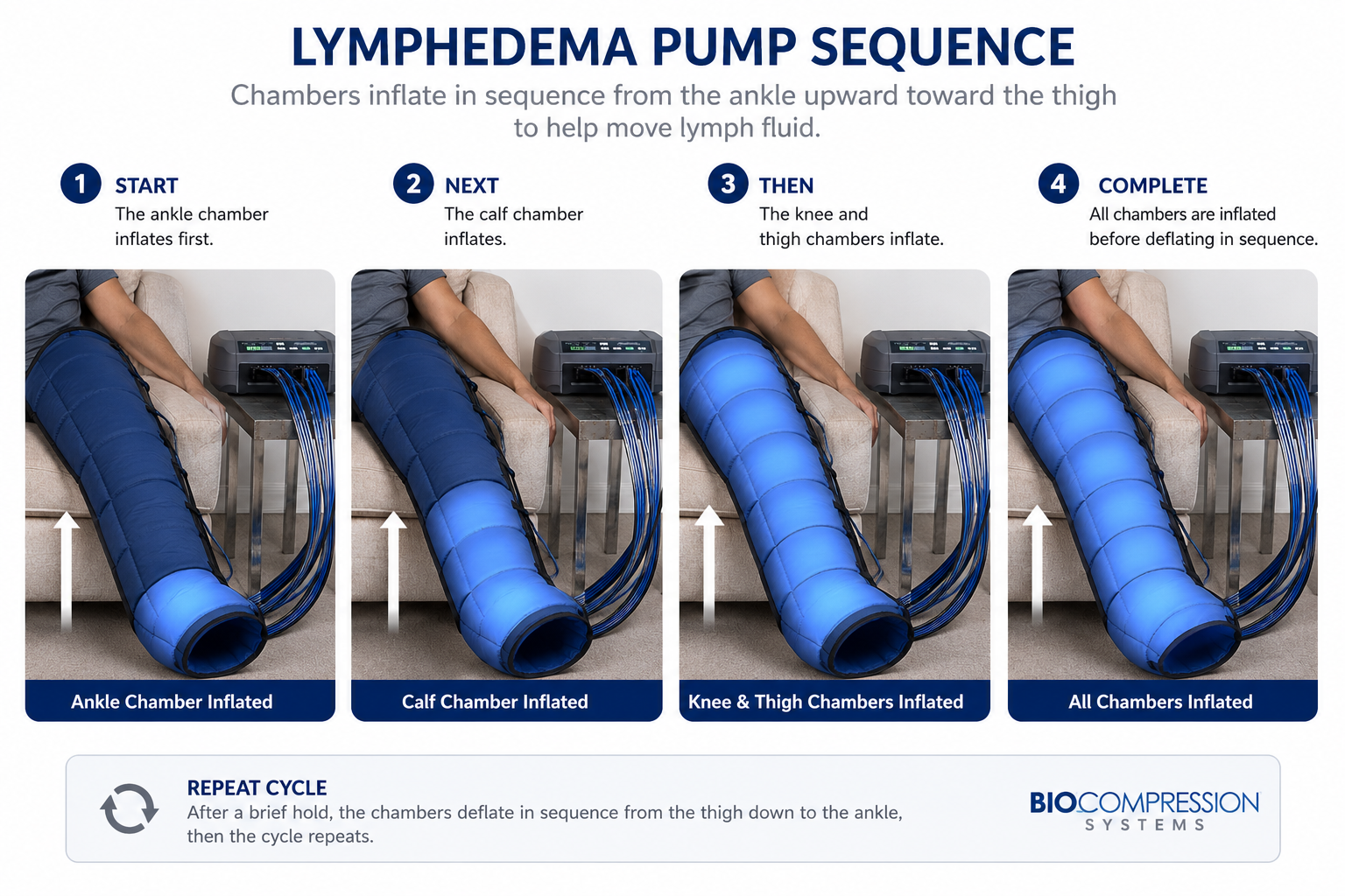 Sequence showing a lymphedema pump's chambers inflating from the ankle upward toward the thigh. Sequence showing a lymphedema pump's chambers inflating from the ankle upward toward the thigh.