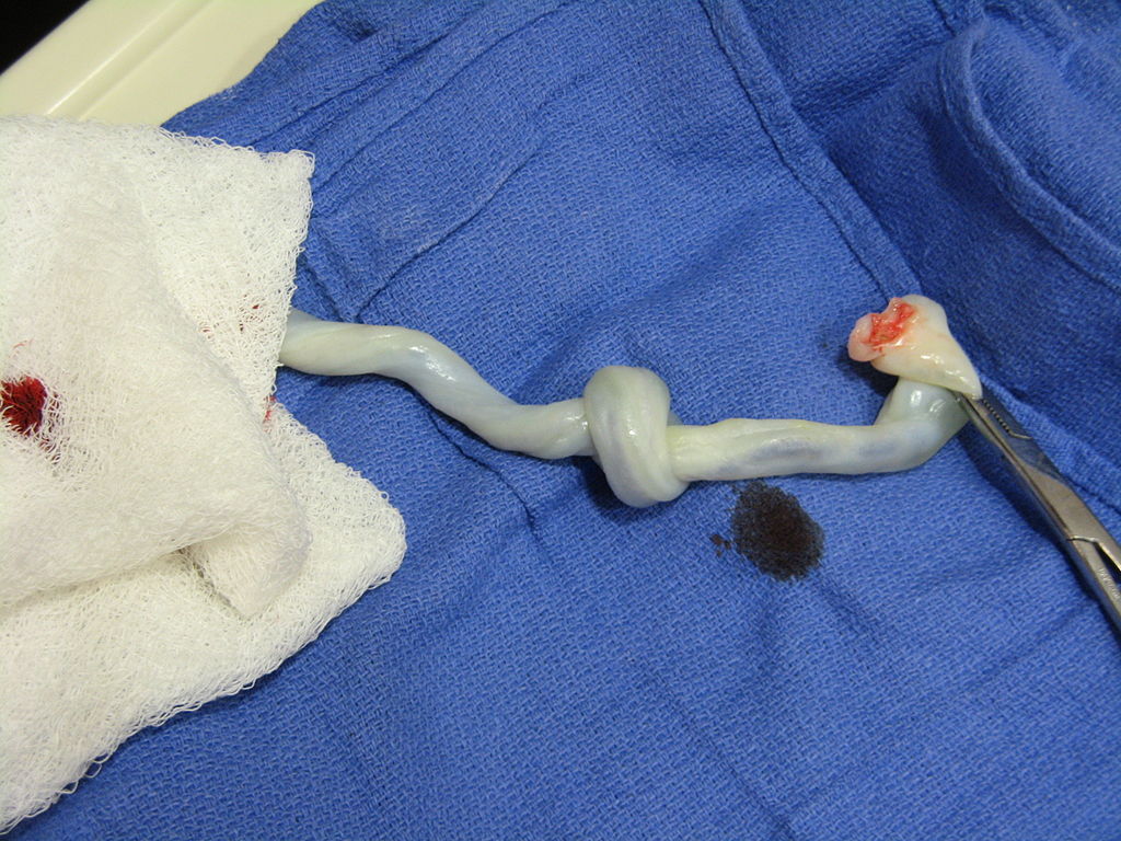 Optimal (Delayed) Cord Clamping | Bell House Doulas
