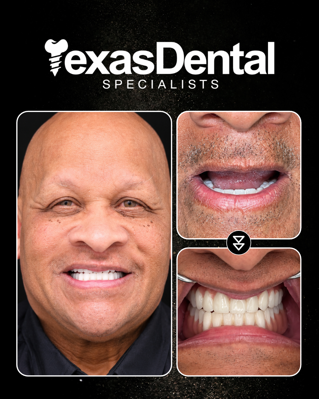 Texas Dental Specialists smile transformation 4, before and after