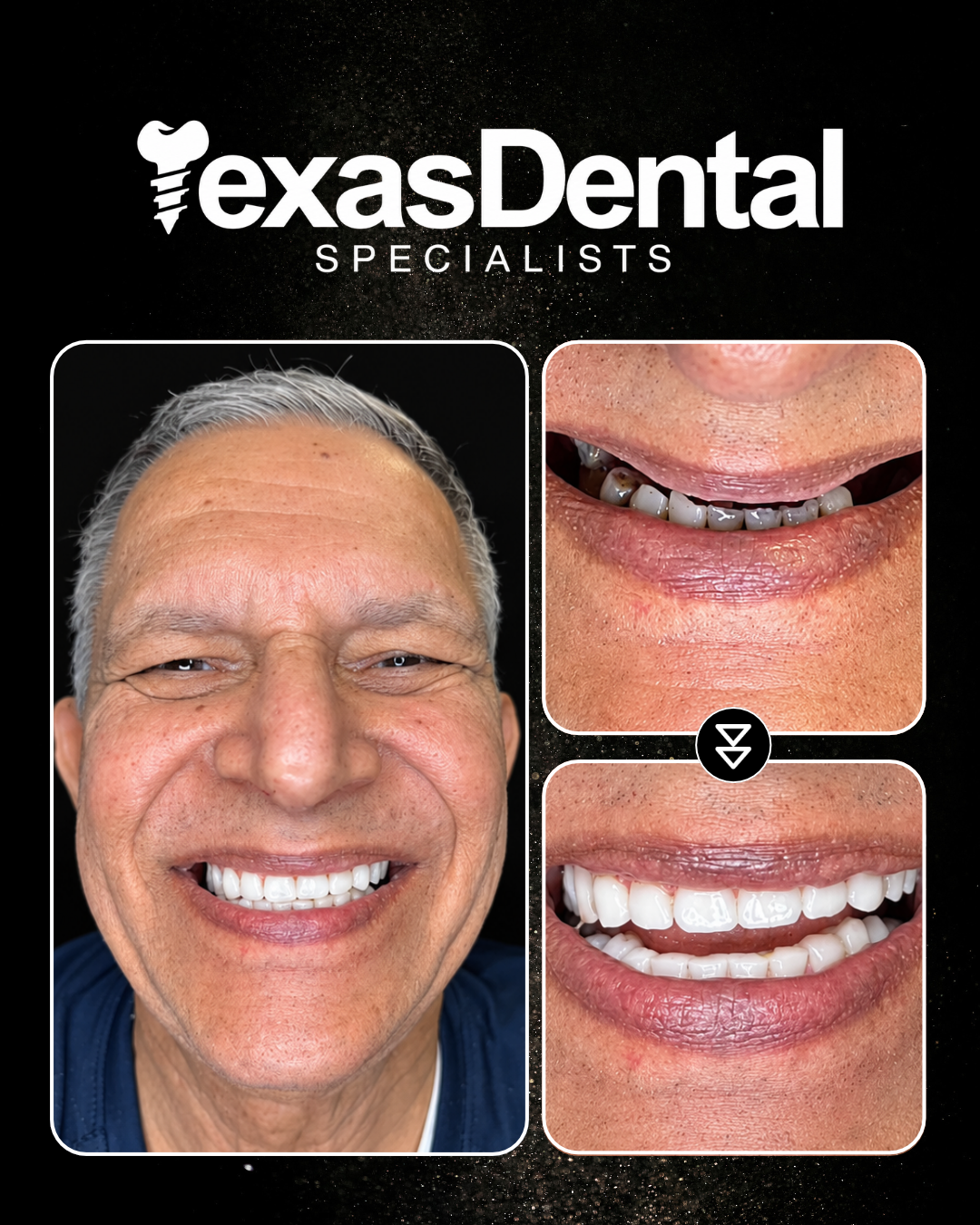 Texas Dental Specialists smile transformation 6, before and after