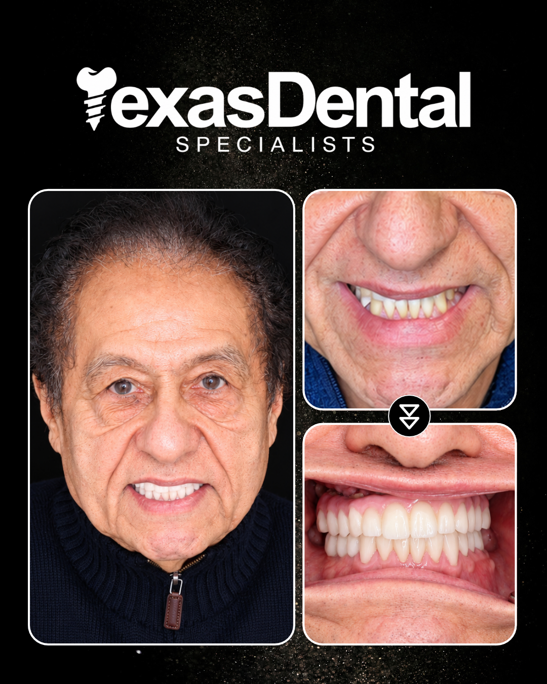Texas Dental Specialists smile transformation 1, before and after