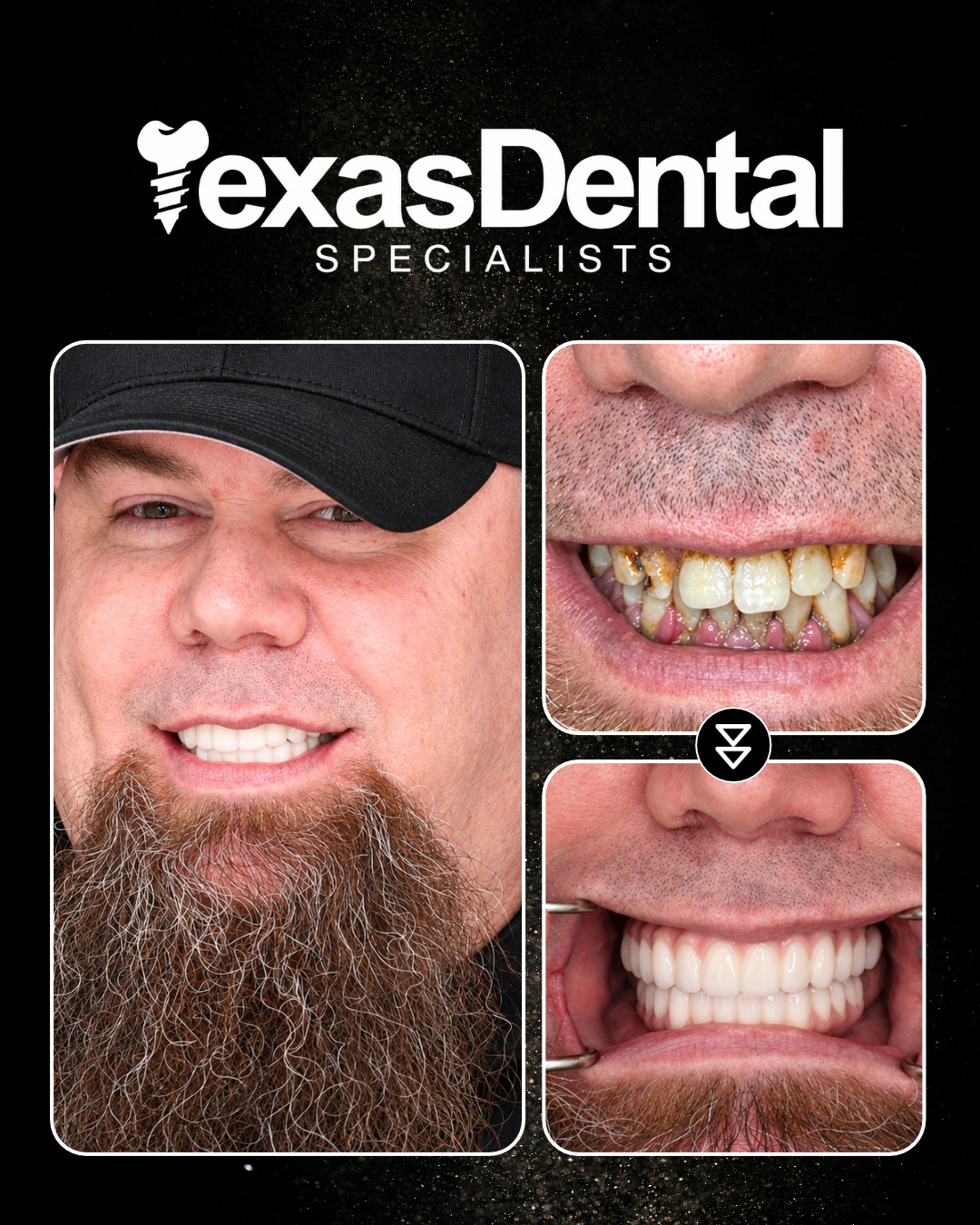 Texas Dental Specialists smile transformation 3, before and after