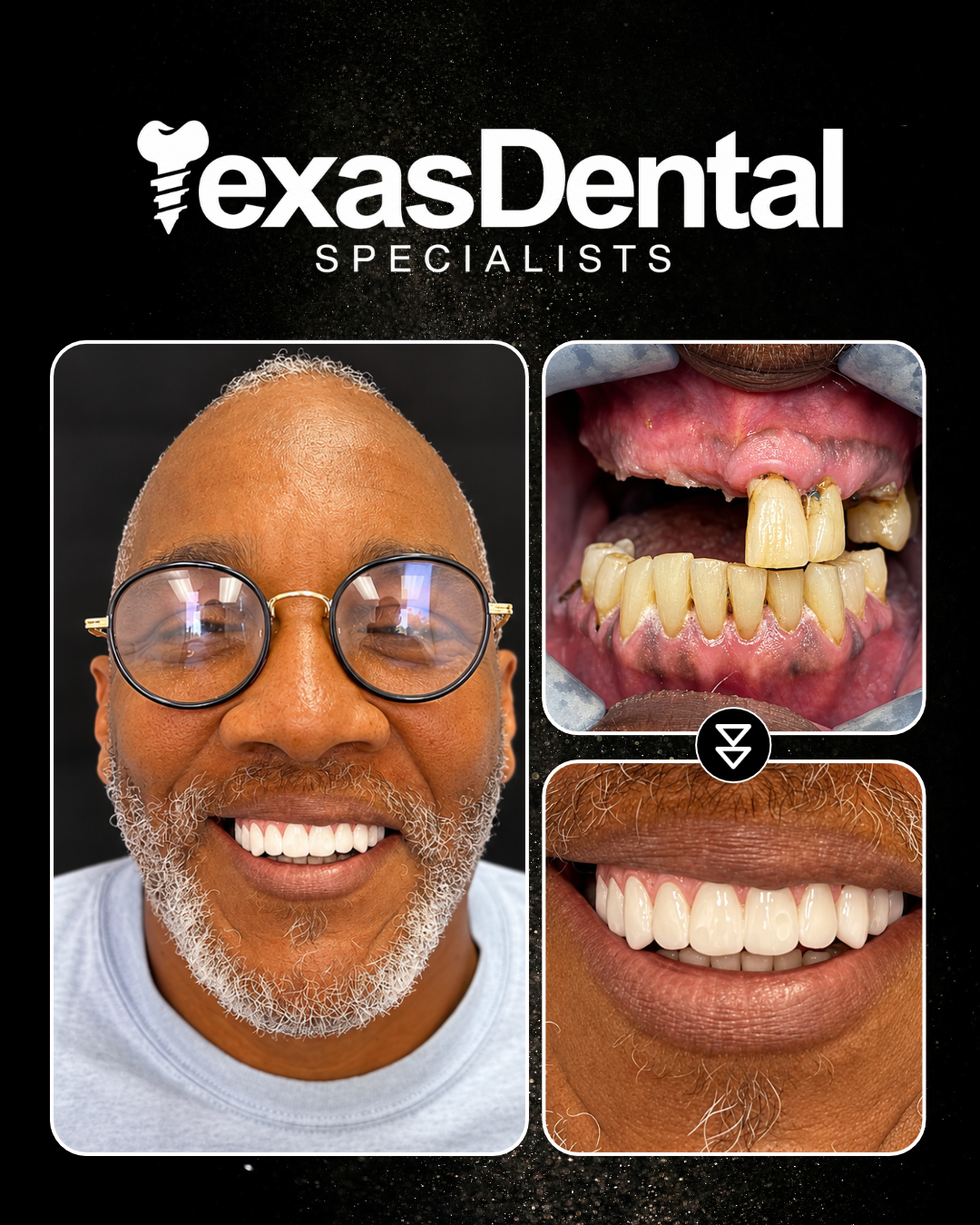 Texas Dental Specialists smile transformation 2, before and after