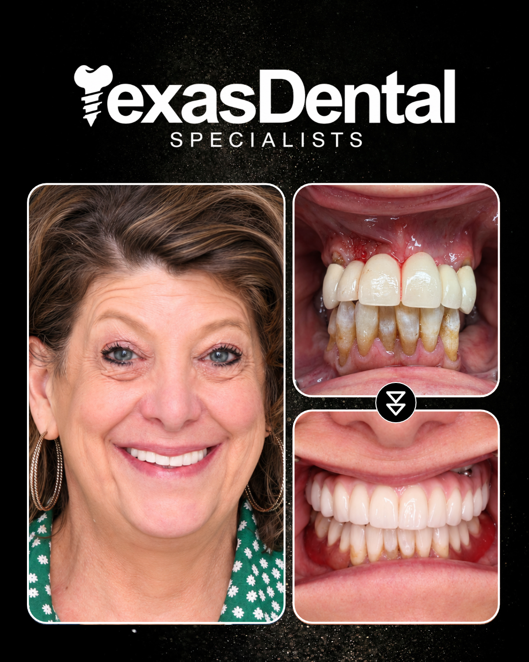 Texas Dental Specialists smile transformation 5, before and after