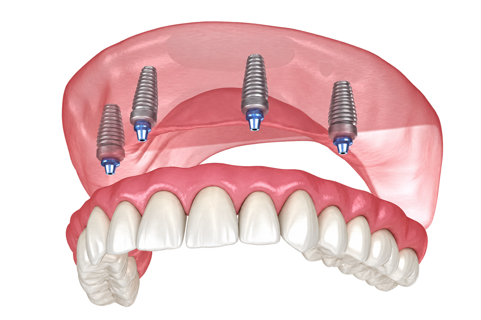 The Lone Star Arch: a complete arch of teeth supported by implants