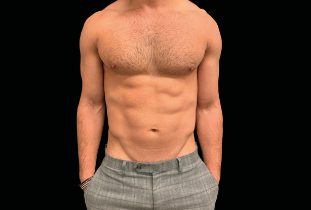 Emsculpt Neo After