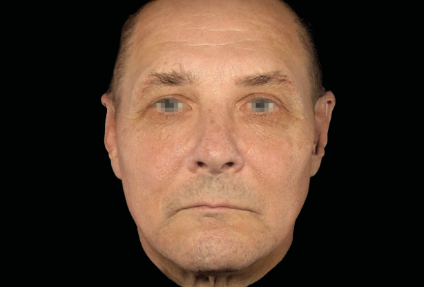 Front-facing jawline and cheek lift Before