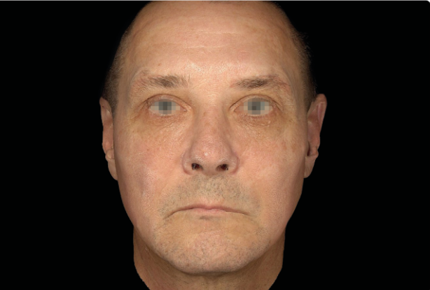 Front-facing jawline and cheek lift After