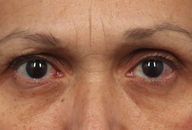Brow and eye area Before