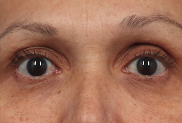 Brow and eye area After