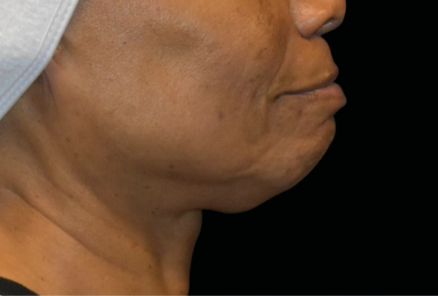 Lower face double chin Before