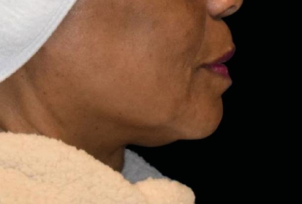 Lower face double chin After