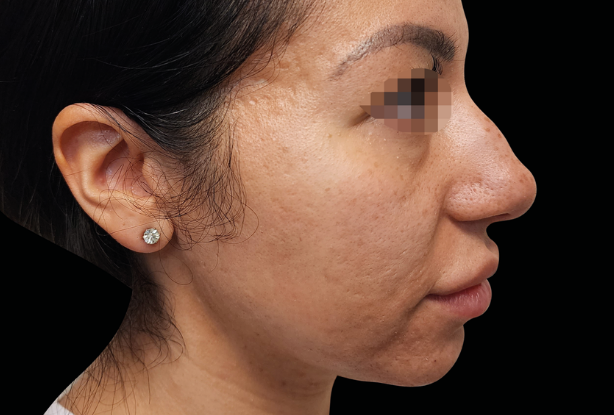 Facial skin texture laxity After