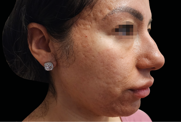 Facial skin texture laxity Before