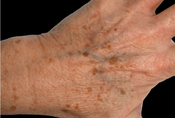 Clear RF skin surface Before
