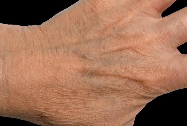 Clear RF skin surface After