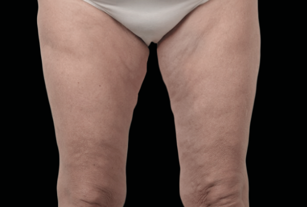 Fractional RF texture After